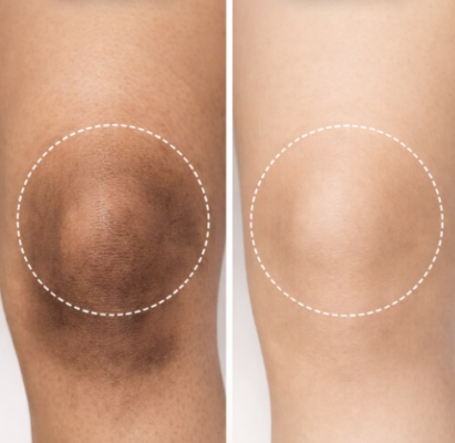 Cách cải thiện tình trạng thâm đầu gối và khuỷu tay