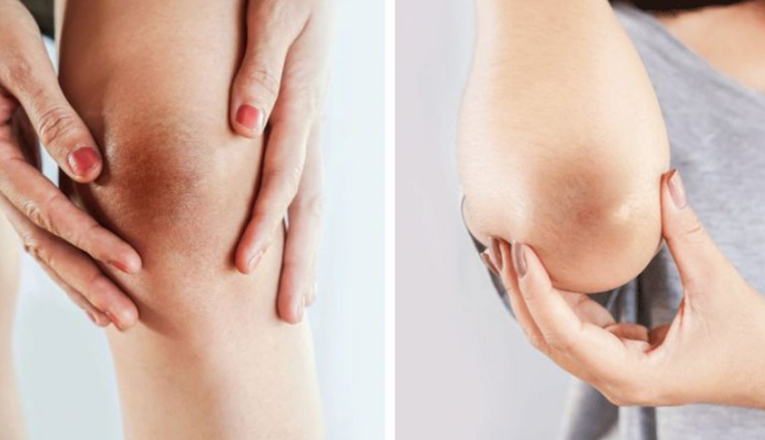 Bao lâu thì đầu gối và khuỷu tay hết thâm?