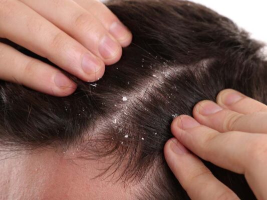 Vì sao gội đầu thường xuyên vẫn có gàu?